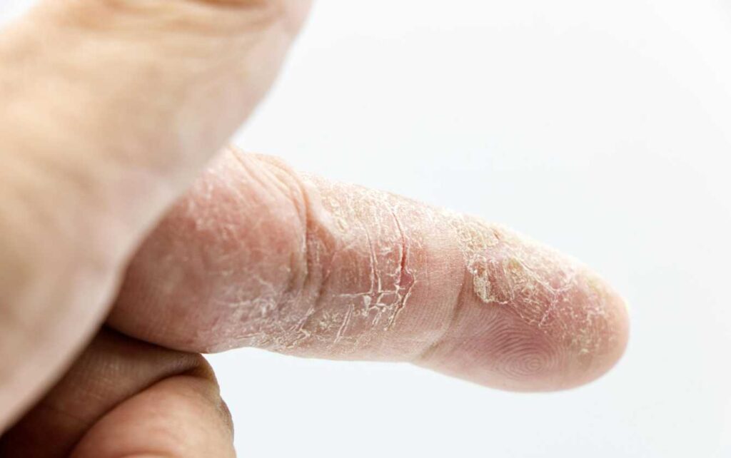 Fiberglass in Skin: Common Symptoms